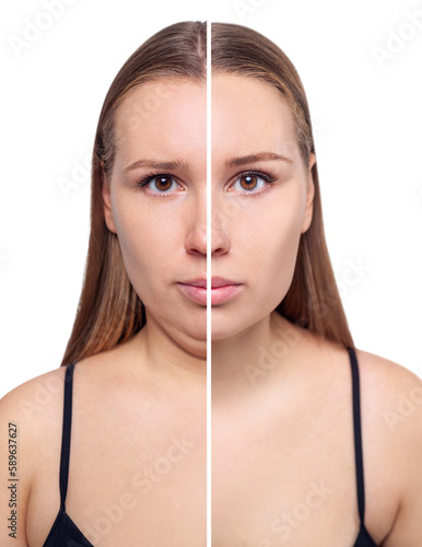 Woman before and after chin correction. Plastic surgery concept.