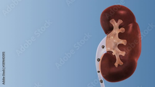 Kidney stones treatment medical concept photo