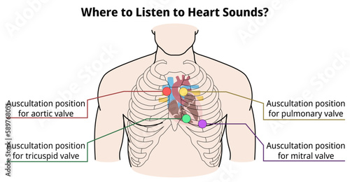 Where to listen to heart sounds? - Auscultation Position of Heart Valve - Vector Medical Illustration