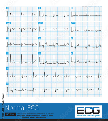 Sometimes, in middle-aged people, small q waves appear in inferior leads of the electrocardiogram, and it is necessary to distinguish between physiological and old inferior myocardial infarction.