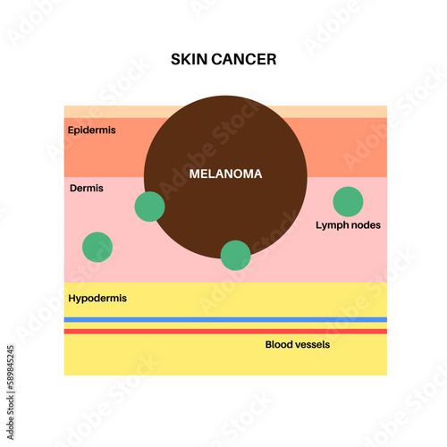 Melanoma graphic poster