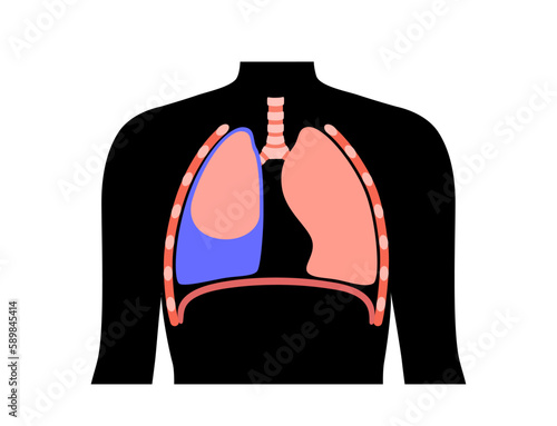 Pleural effusion poster