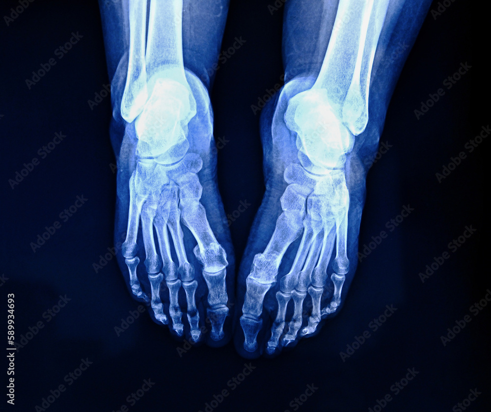 Xray of foot on dark background, radiograph of feet Stock Photo