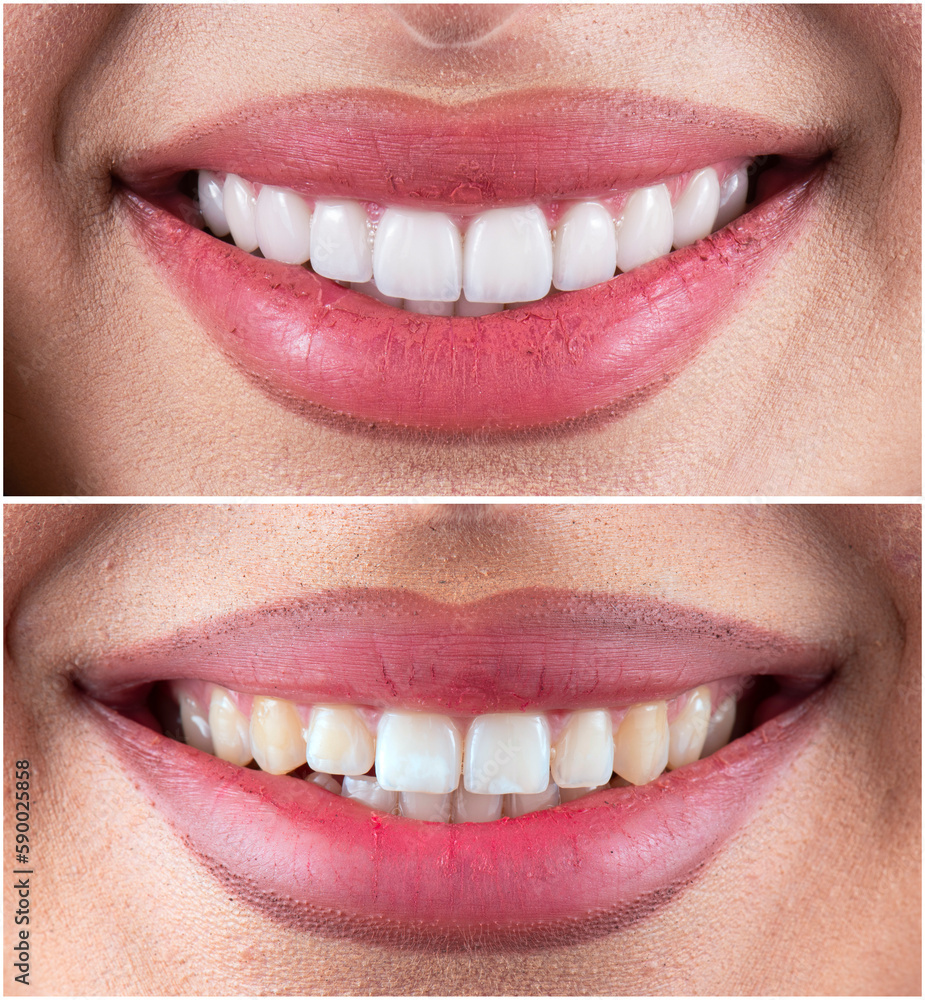 before and after picture of ceramic restorations on teeth by emax and ...