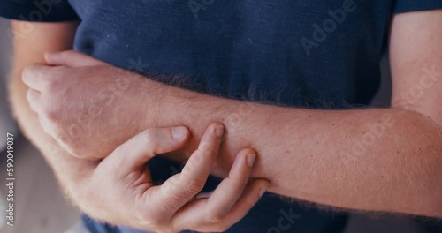 Male skin with Hyperpigmentation. dark spots on hairy arm of man, close-up photo