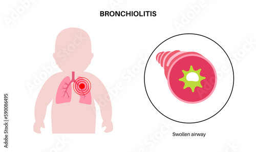 Bronchiolitis lung disease