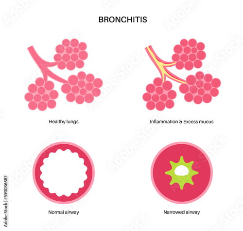 Bronchitis lung disease