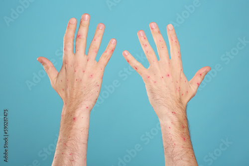 Man with rash suffering from monkeypox virus on light blue background, closeup