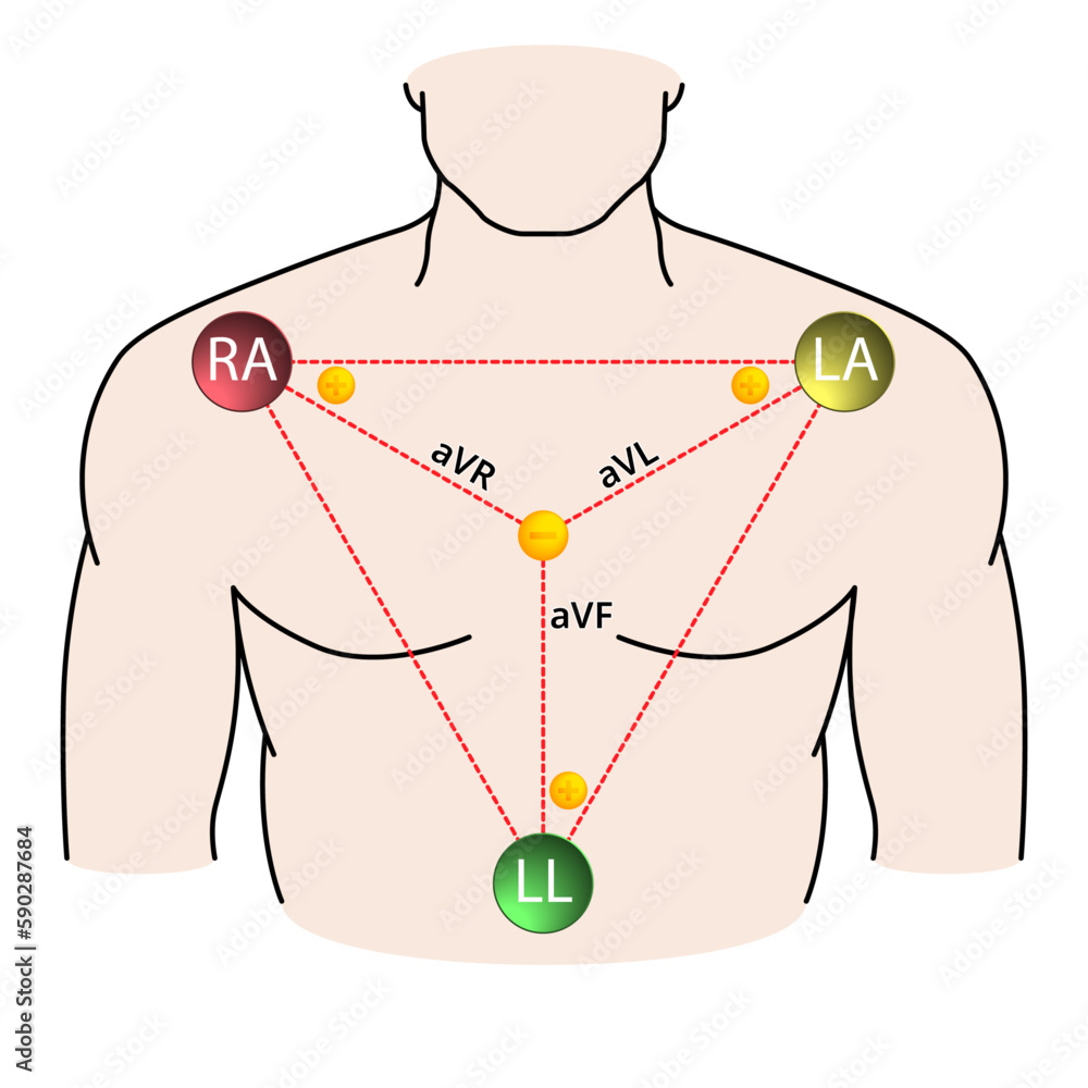 Augmented Limb Leads ECG - Einthoven Triangle - Electrocardiogram ...