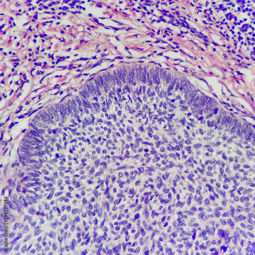 Camera photo of a basal cell carcinoma, showing characteristic nuclear palisading at periphery, magnification 400x, photograph through a microscope photo