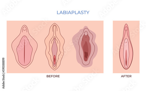 Labiaplasty. vaginoplasty. women genital of minor Vulval labia loose lips beauty surgery to tighten photo
