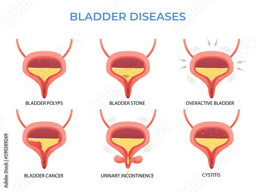 Urology and urinary system. BLADDER DISEASES