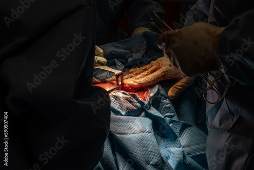 Hip Surgery in Progress: Detailed Footage of Surgeons in the Operating Room