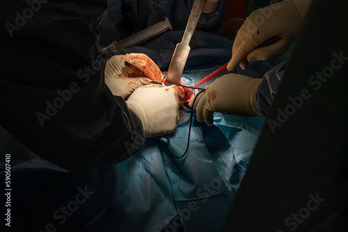 Hip Surgery in Progress: Detailed Footage of Surgeons in the Operating Room