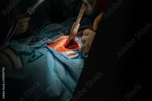 Hip Surgery in Progress: Detailed Footage of Surgeons in the Operating Room