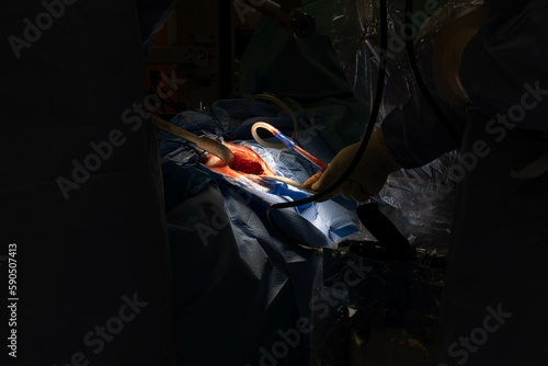 Hip Surgery in Progress: Detailed Footage of Surgeons in the Operating Room