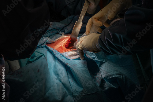 Hip Surgery in Progress: Detailed Footage of Surgeons in the Operating Room