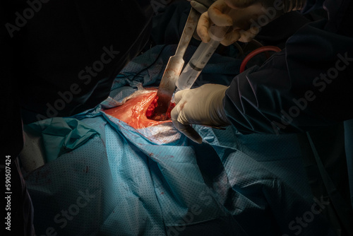 Hip Surgery in Progress: Detailed Footage of Surgeons in the Operating Room