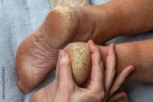 Cracks on the heels of a person's foot, foot health problems, neglected heel of a person. A doctor examines a man's cracked heels. Close-up. The concept of treating cracked heels photo