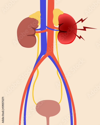 Urinary system with a diseased inflamed kidney. Flat style.