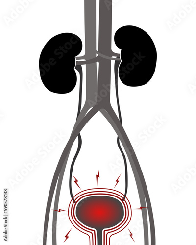 Inflammation of the bladder. Cystitis. Urinary system. 