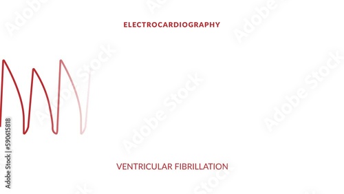 animated ventricular fibrillation. animated ekg display