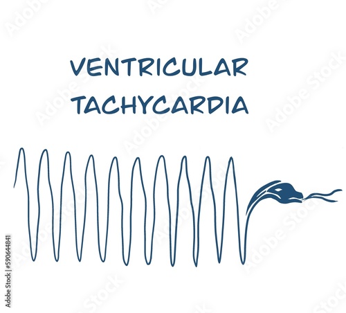monomorphic ventricular tachycardia findings on electrocardiogram with snake vector illustration
