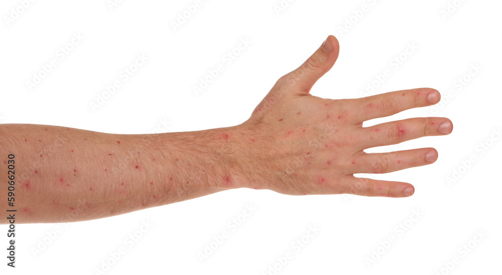 Man with rash suffering from monkeypox virus on white background, closeup