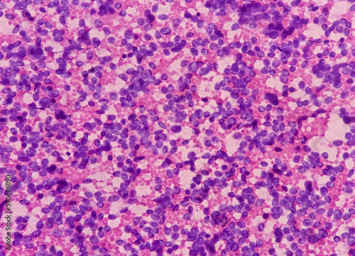USG guided FNA cytology from liver SOL. Non-Hodgkin lymphoma. Smear show atypical small round cells and inflammatory cells and blood background. Metastatic carcinoma. photo