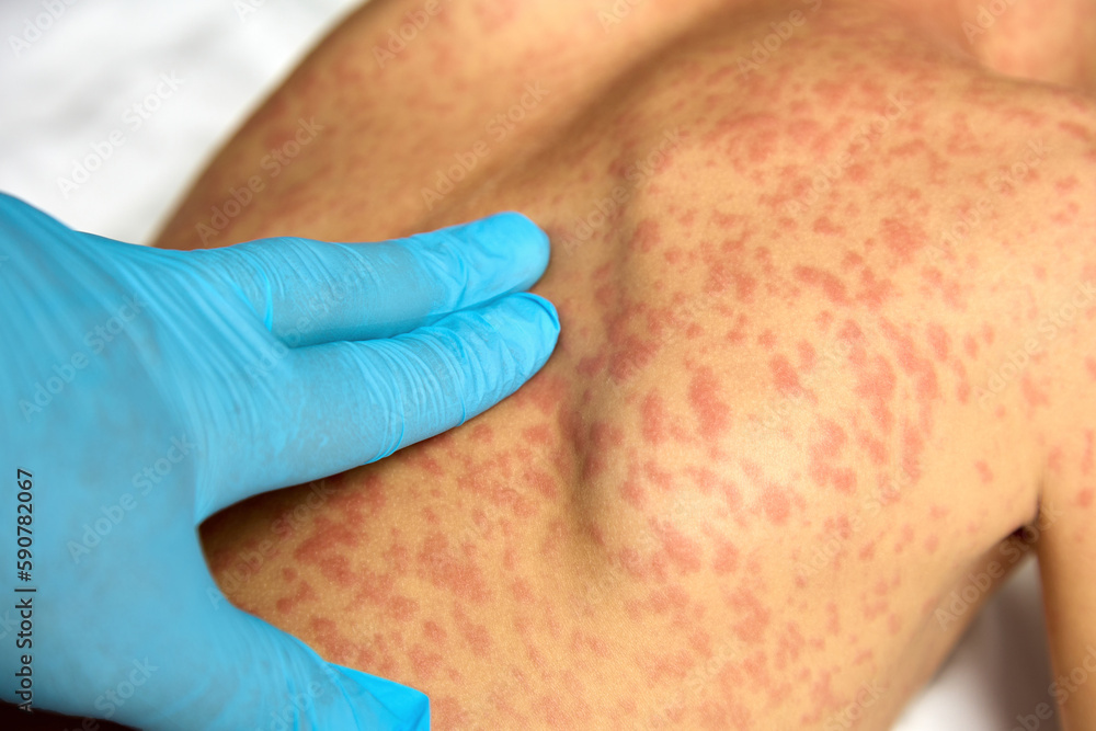 Small child with atopic dermatitis in the acute stage. Allergic redness