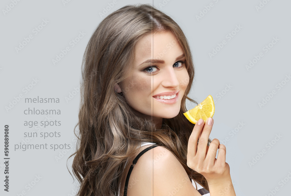 Dark spots, freckles,hyperpigmentation(melasma or chloasma),concept - skin lightening, skin whitening, fruit acids,AHA, Skin Brightening Dark spots, freckles,hyperpigmentation(melasma or chloasma),concept - skin lightening, skin whitening, fruit acids,AHA, Skin Brightening
