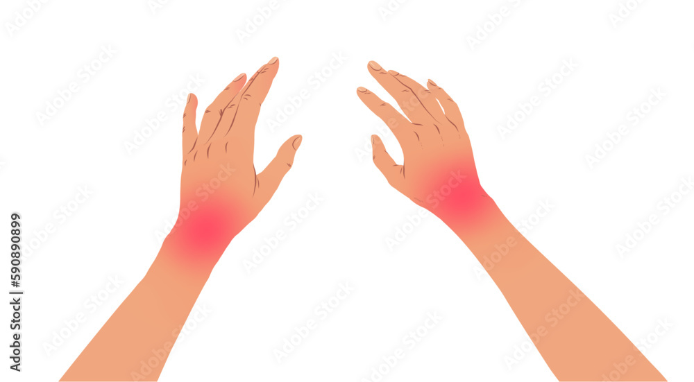 Vector illustration of hands with carpal tunnel syndrome