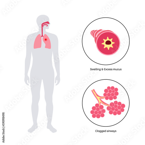 Bronchitis lung disease