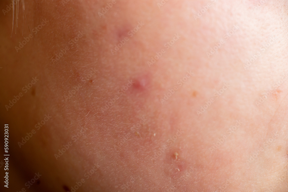 Skin with close-up macro pimples. Skin problems, dermatology.