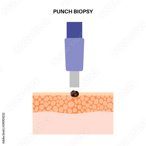 Punch biopsy procedure