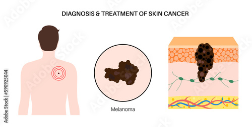 Skin cancer diagnosis