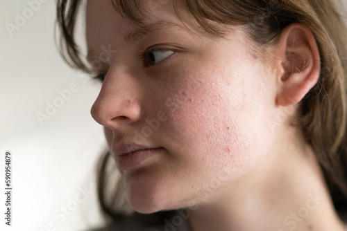 Картината върху платно Problem skin face