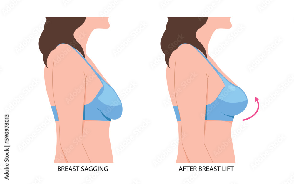 Breast fat transfer lift asymmetrical nipple sag rejuvenate surgery  implantation small size droop Stock Vector