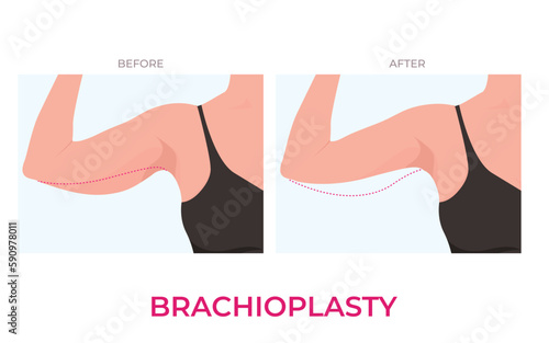 Brachioplasty or Upper Arm Lift plastic surgery in woman. Front view