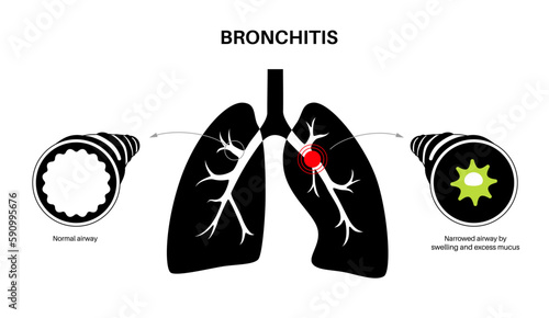 Bronchitis lung disease