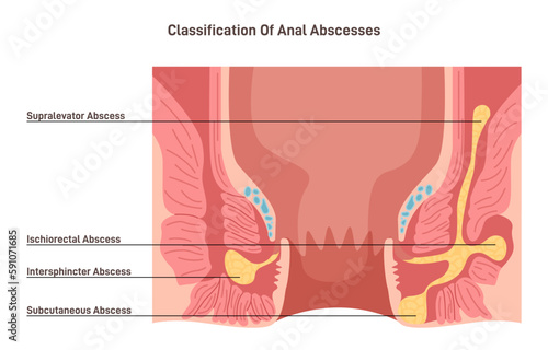 Anal abscess. Perianal abscess, lump filled with pus found near the anus photo