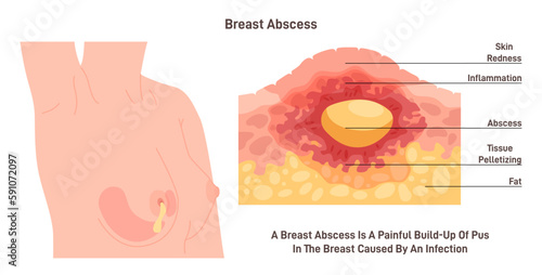Breast abscess. Cross-section of the female chest with inflammation