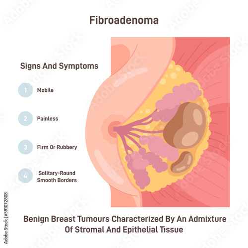 Fibroadenoma. Neoplasm in female chest. Benign breast tumour