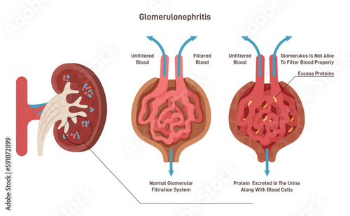 Glomerulonephritis or glomerular nephritis. Kidney disease, inflammation photo