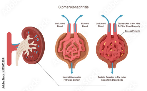 Glomerulonephritis or glomerular nephritis. Kidney disease, inflammation
