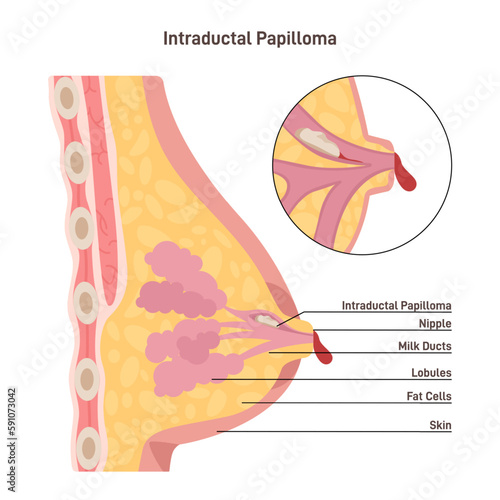 Intraductal papilloma. Human papilloma virus, HPV neoplasm in the mammary