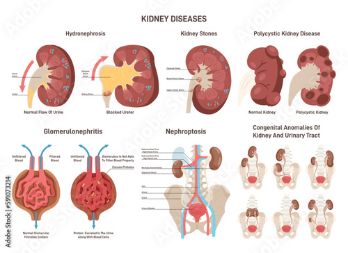 Kidney diseases set. Renal failure, urinary system organ medical