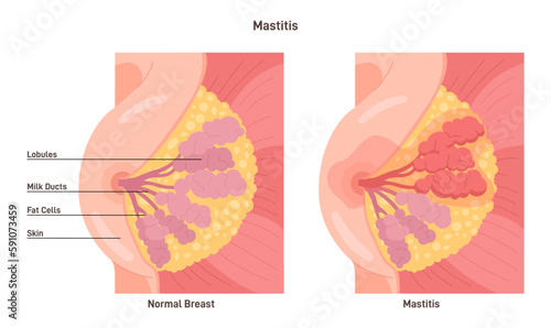 Mastitis. Mammary gland with inflammation of the breast lobular