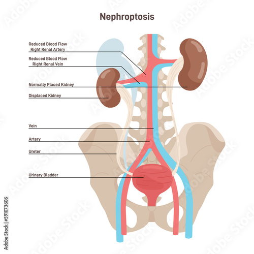 Nephroptosis. Floating kidney or renal ptosis, condition in which the kidney photo