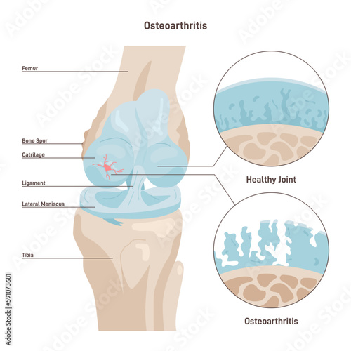 Osteoarthritis. Degenerative joint disease. Worn out knee cartilage.